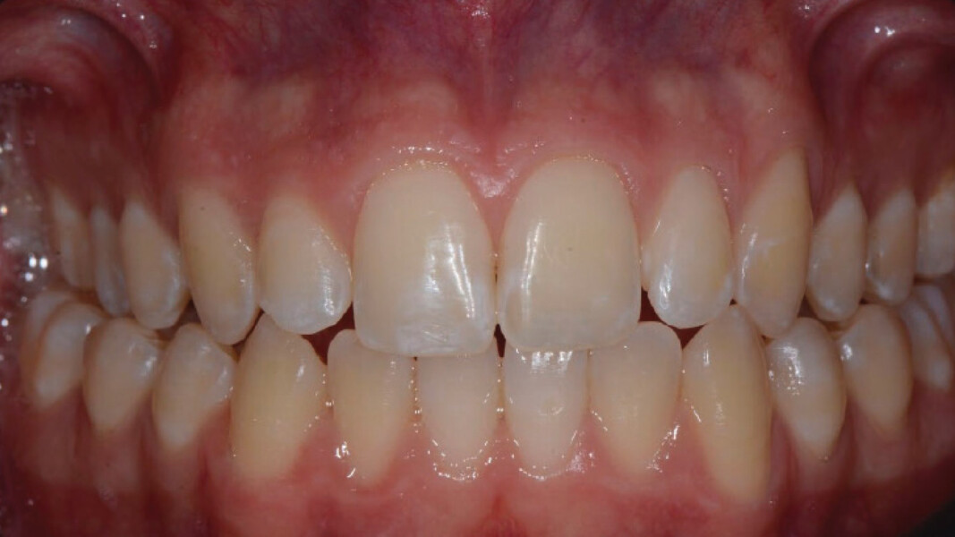 Figg. 9, 10 - Visione polarizzata che evidenzia le white spot lesions.