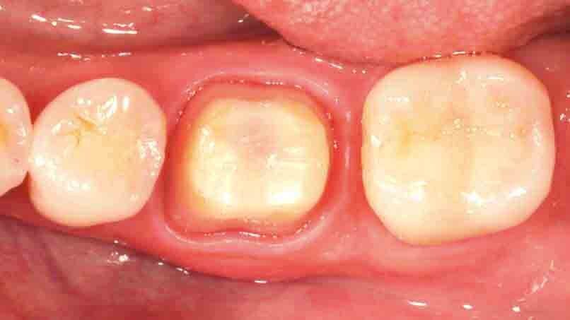 Fig. 5: One week after the preparation procedure, healthy soft tissue conditions are obtained. They lay the foundation for a high-quality precision impression.