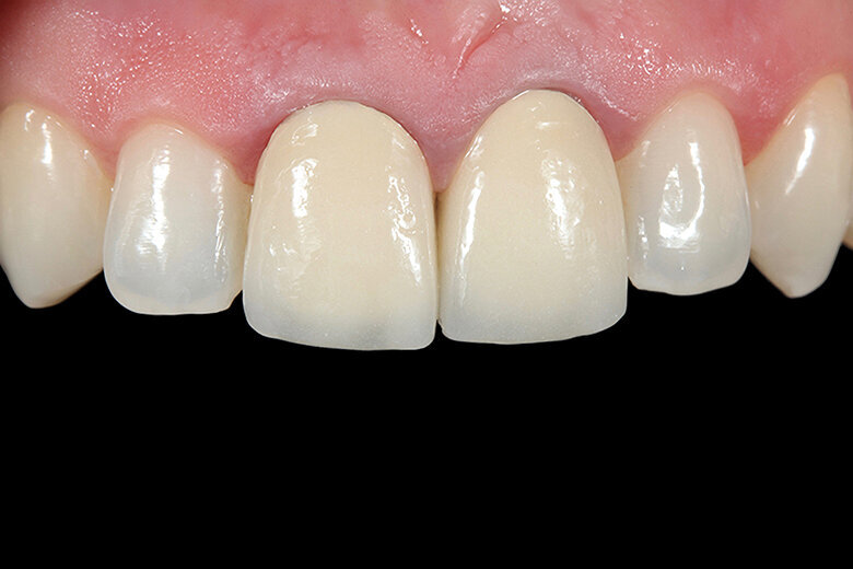 Fig. 1. Situación inicial en la que las coronas metal-cerámicas de los dientes 11 y 21 presentaban déficits estéticos. En los dientes 21 y 22 se habían colocado carillas cerámicas para obtener una transición más natural hacia los dientes adyacentes.

