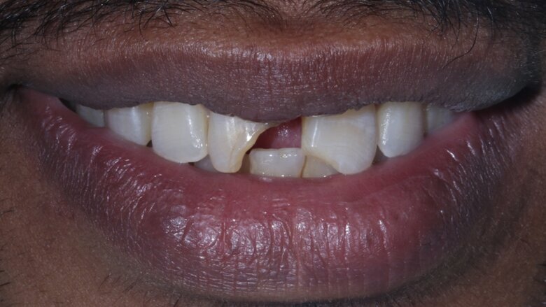 Fig 1 Pre-op smile