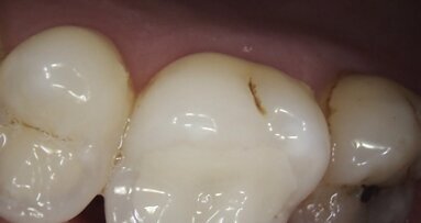 Removal of leaking amalgam restorations and placement of ceramic CAD/CAM inlays in one-hour