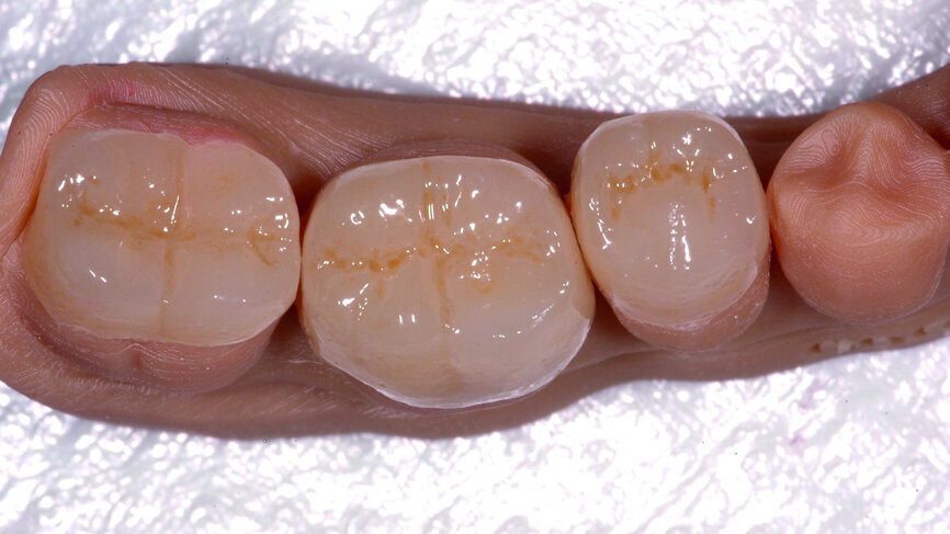 Fig. 8 : E-max usinée et maquillée