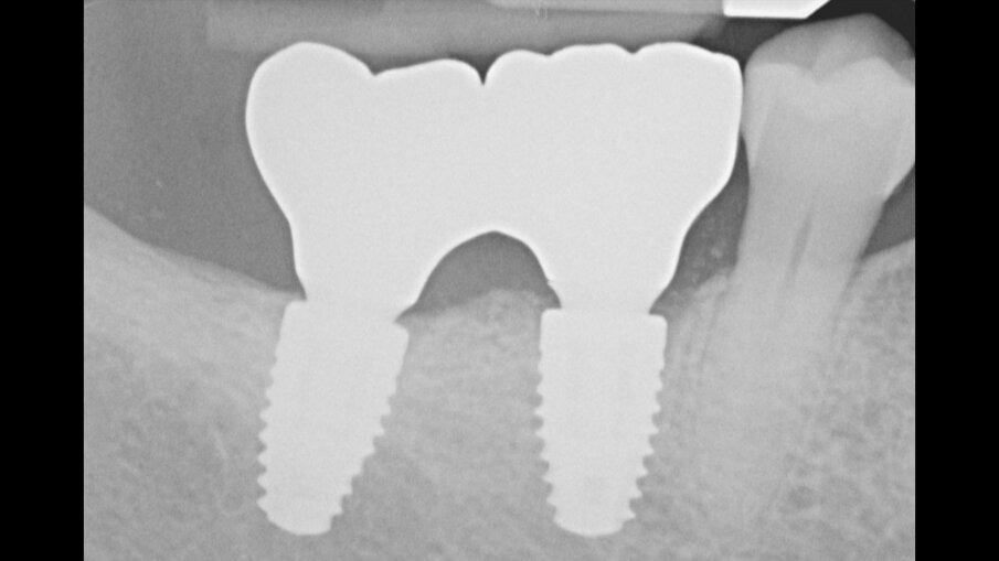 Figg. 19a, 19b_Immagine clinica e radiografica che mostrano il manufatto protesico finale.