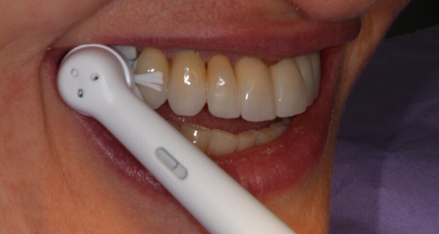 Fig. 2 - Testina Gentle Clean su struttura implanto-protesica full arch.