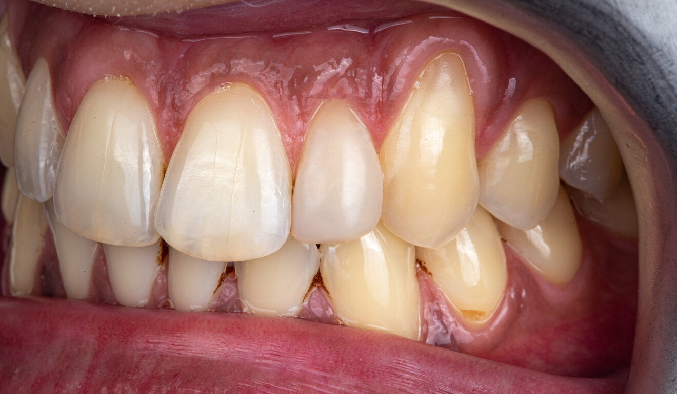 Fig. 11: Well-polished and unstained surface of the restoration after six months.