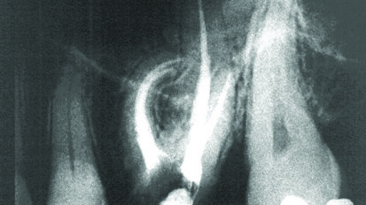 Taktilna percepcija u endodonciji