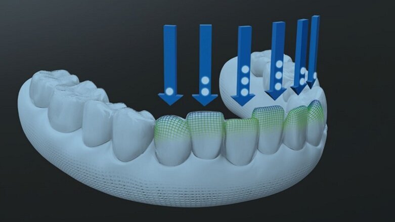 Siła Invisalign G8 – jeszcze bardziej skuteczne leczenie nakładkami