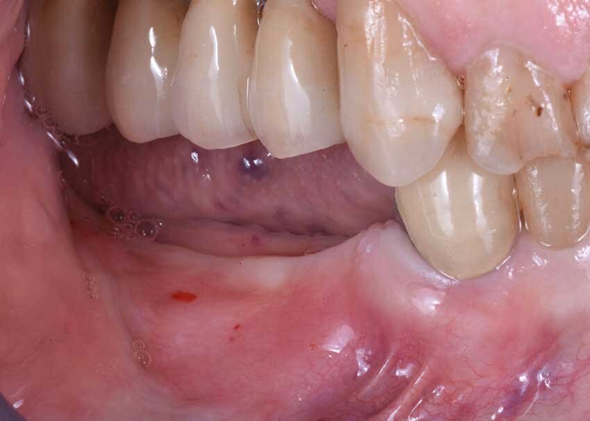 Fig. 2 -  Close-up della zona edentula.