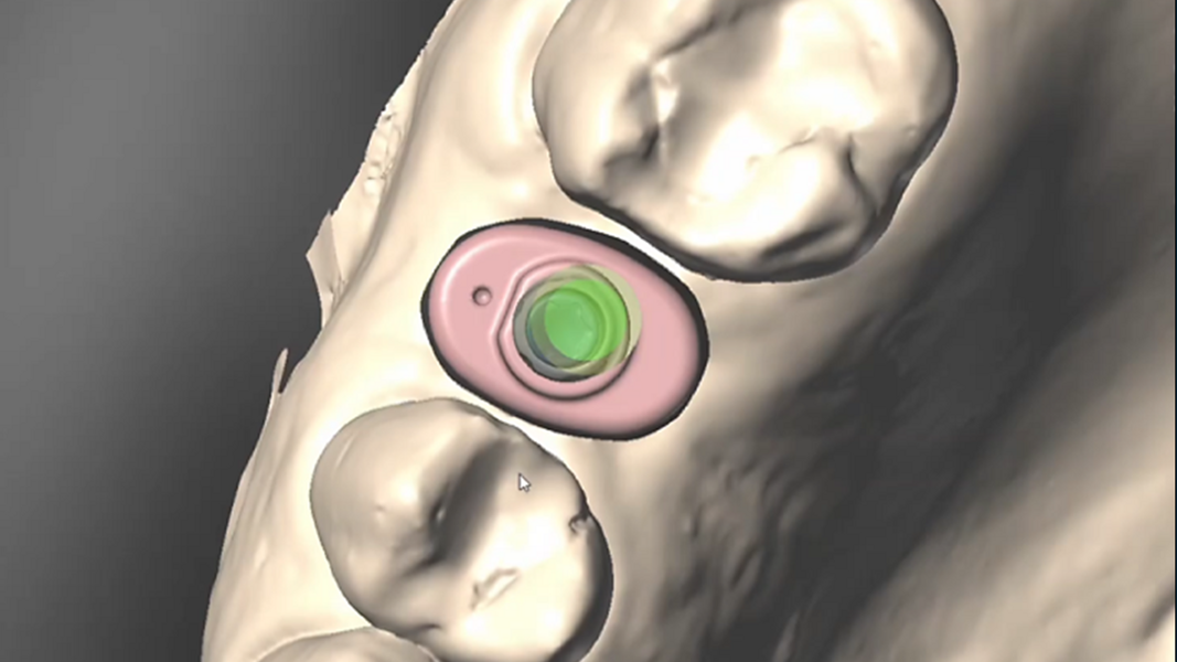 Fig. 13: Digital impression taken with Straumann SIRIOS.