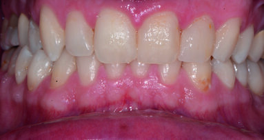 Approccio preventivo e cosmetico per lesioni smalto post trattamento ortodontico. Case report