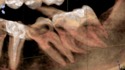 CBCT nel trattamento di un secondo e terzo molare mandibolare fusi