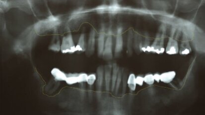 Riabilitazione bimascellare su impianti in paziente con iperplasia mascellare: step-to-step