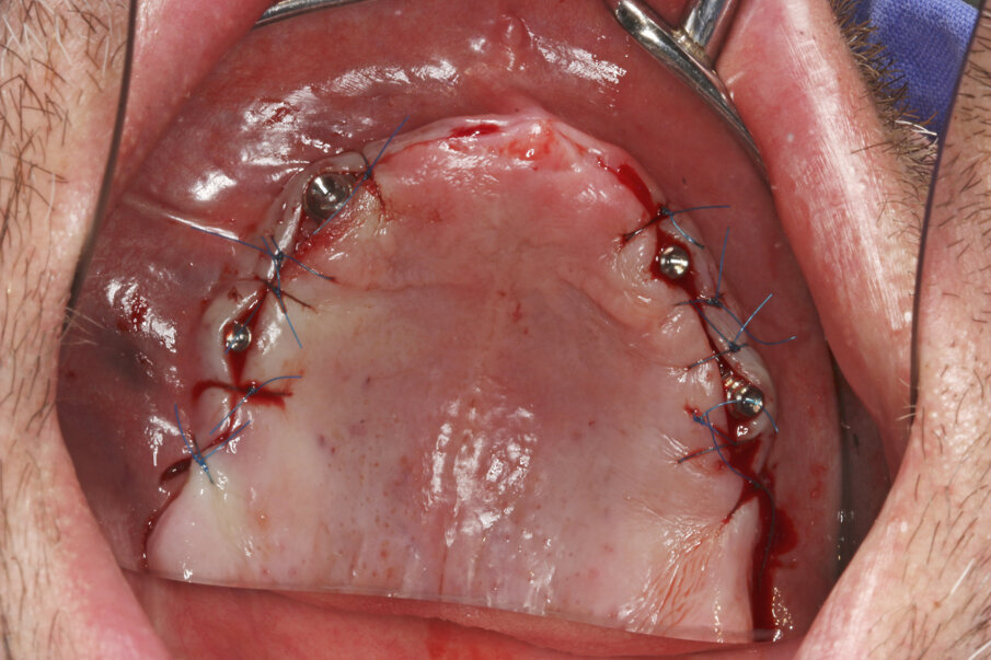 Fig. 7: Multibase abutments inserted for immediate loading.