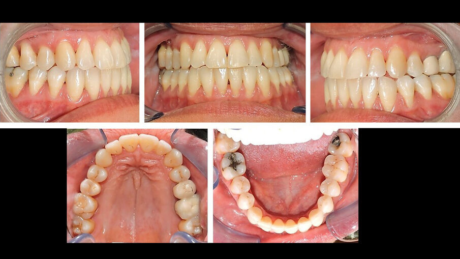 Fig. 14_Immagini intraorali con mantenimento della simmetria occlusale, dopo 2,5 anni dalla conclusione della terapia.