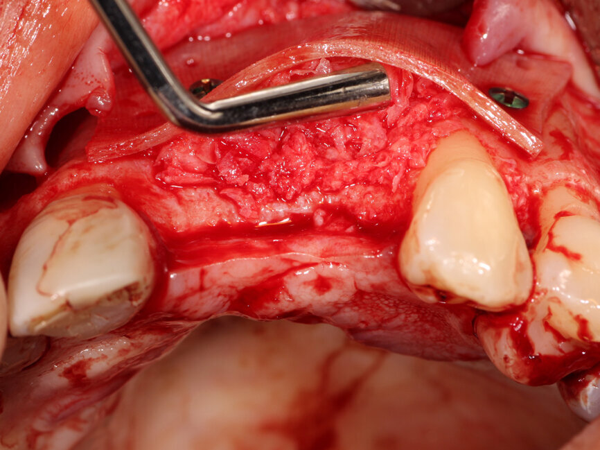 Fig. 12: The PRP autogenous and particulate graft (‘gummy bone’) is placed into the space between the stabilized Flexo-Plate and the deficient edentulous ridge.