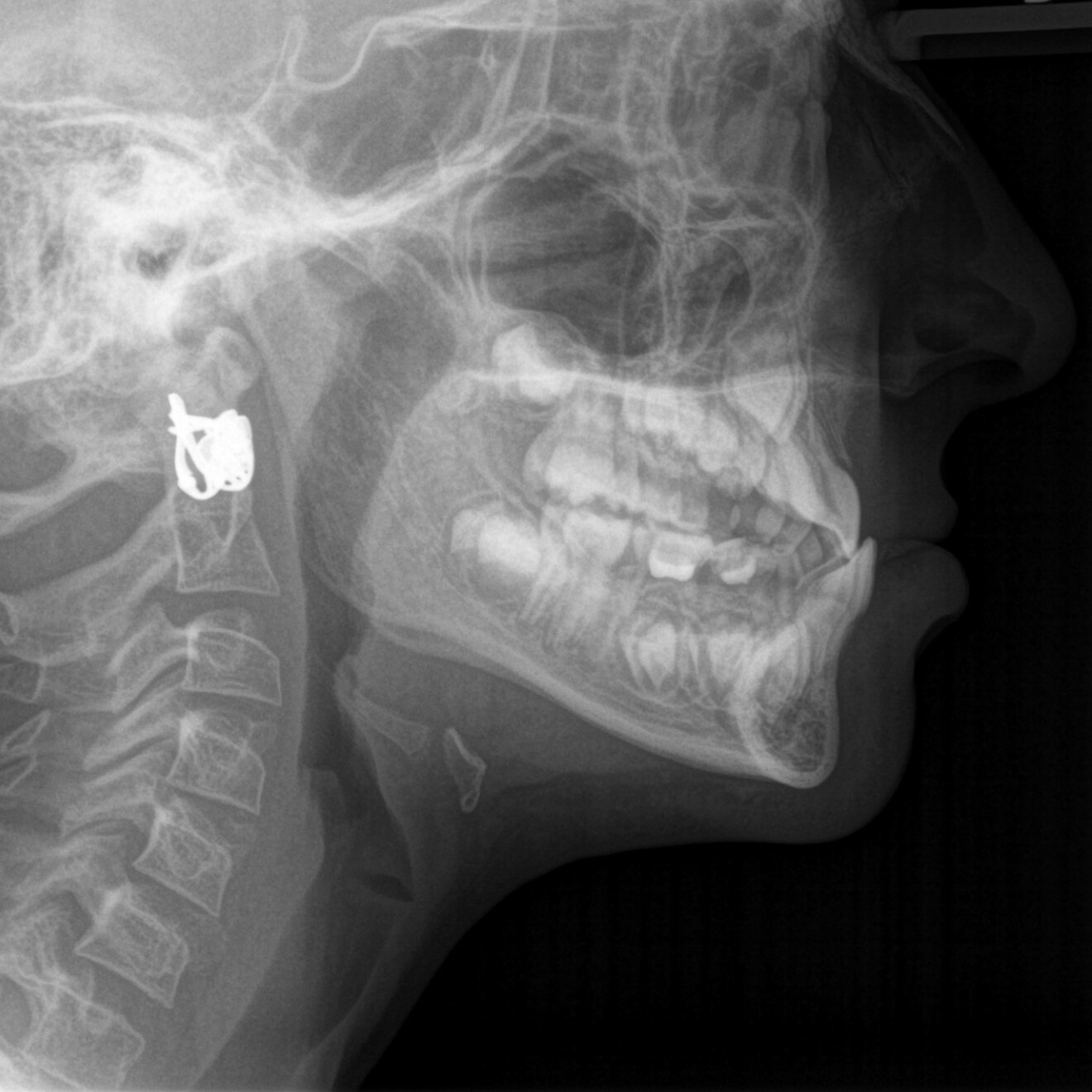 Fig. 3a: Pre-treatment cephalometric radiograph.