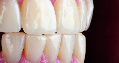 Résine composite injectable : une nouvelle technique – Part I