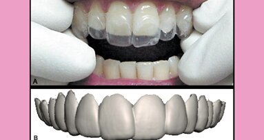Estética y blanqueamiento dental en la era digital (Capítulo 4)