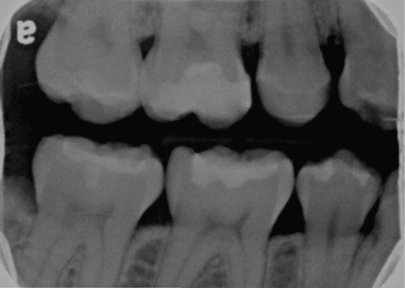 Fig. 10: Two-year follow-up bitewing radiograph showing retraction of the mesial pulp horn.