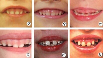 WDR26 haploinsufficiency may cause abnormalities in facial features