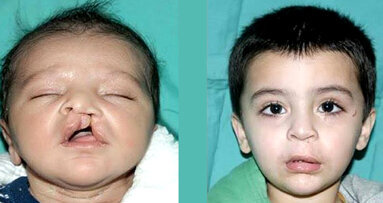 ICLAPA vows to continue free cleft lip and palate treatment