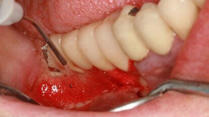 Traitement laser assisté des péri-implantites