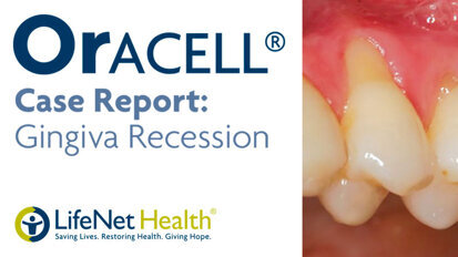 Patient with severe gum recession treated with Oracell.