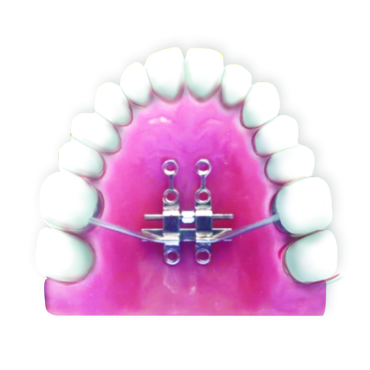Fig.6 Bone- tooth anchored design: 4 anterior TADs 2 posterior TADs and support of molars
