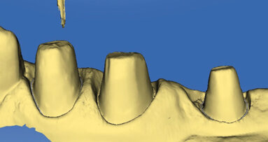 Il flusso digitale nella realizzazione di corone CAD/CAM in disilicato di litio su denti naturali preparati senza linea di finitura