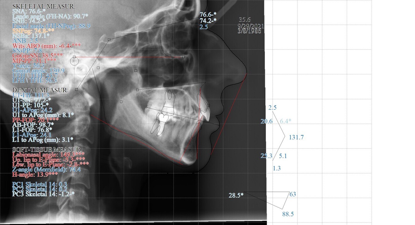 Fig. 4: Pretreatment cephalometric radiograph and analysis.