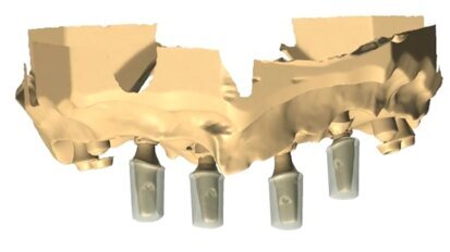 Kompleksowe postępowanie w leczeniu implantologicznym szczęki z zastosowaniem CBCT i CAD/CAM