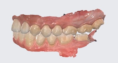 AI-based chairside crown design: A single posterior case using Dentbird Crown
