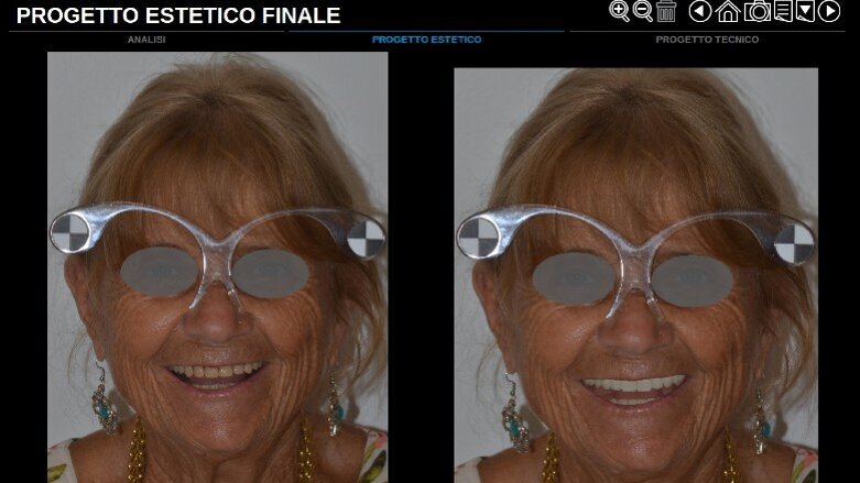 Sviluppo di un progetto interamente digitale dedicato alla protesi totale