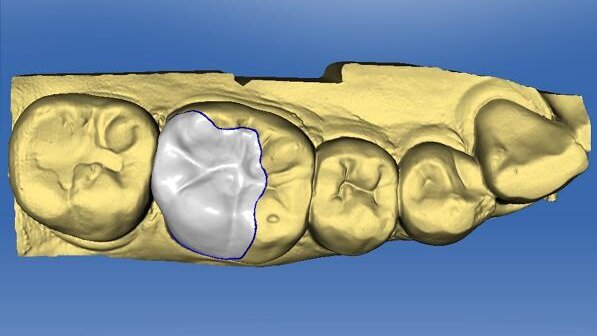 The digitized occlusion: Using something old with something new