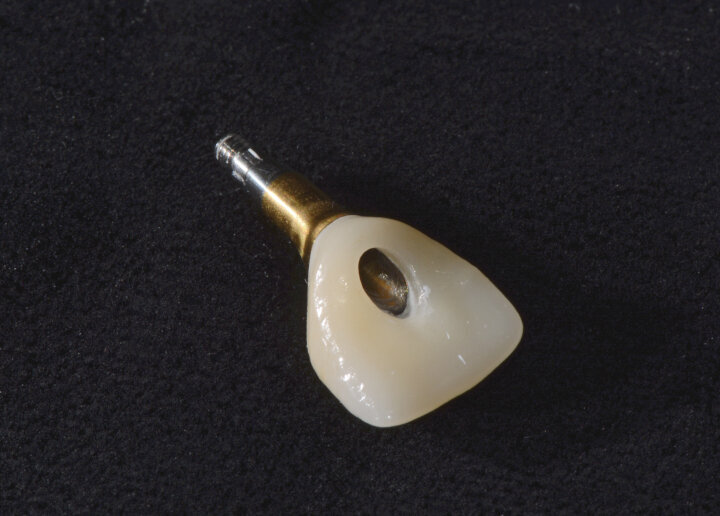 Fig. 8: The completed screw-retained IPS e.max crown ready to be cemented extra-orally with the Atlantis abutment (titanium nitride abutment surface).