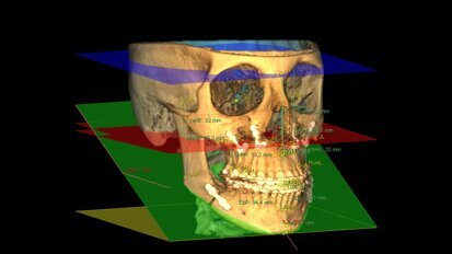 La cefalometria 3D nella pratica ortodontica: continuiamo a parlarne