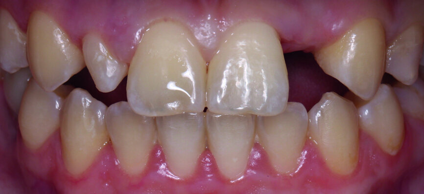 Fig. 1: The patient’s upper teeth before treatment.
