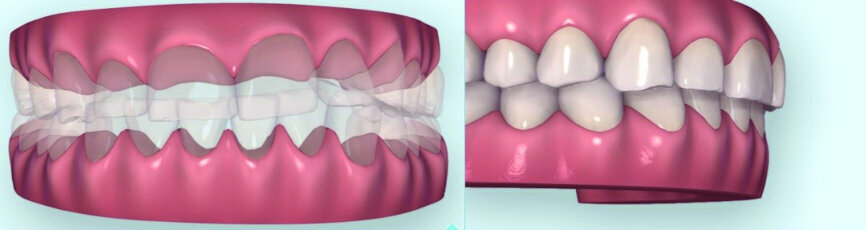 Fig. 3: Clinical situation initially. Worn anterior dentation and compensatory overeruption.