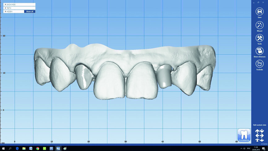 Fig. 14: The final restorations were designed in Planmeca PlanCAD Premium.