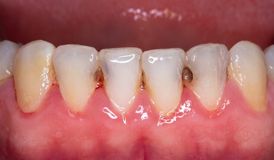 Fig. 1: Initial situation. Several carious lesions were evident in the mandibular anterior teeth.