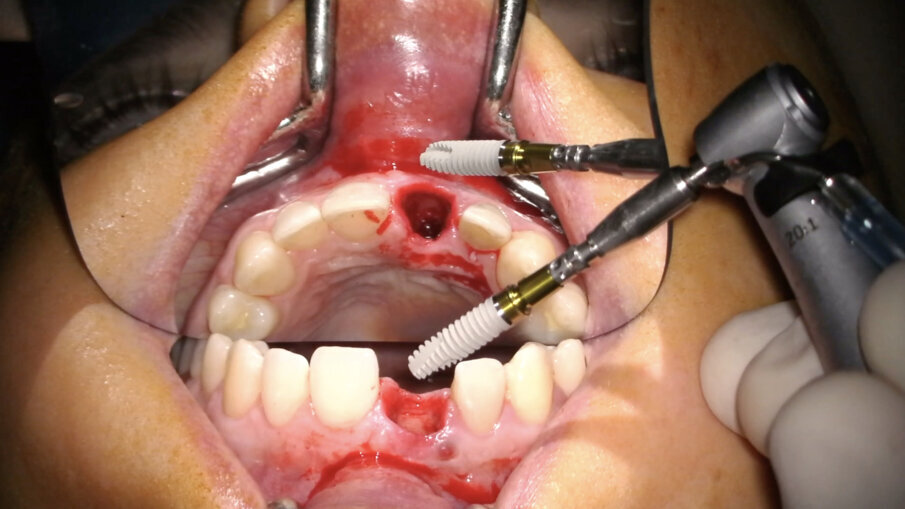 Fig. 16_Inserimento dell’impianto Xive FX 3.8.