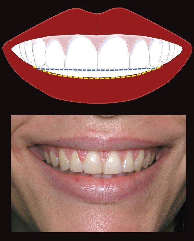 Fig 2: Flat smile