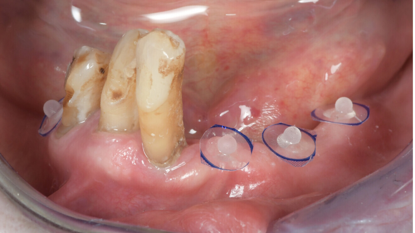 Fig. 5: Intra-oral view of the mandible showing the partial edentulism and stickers with radiopaque beads.