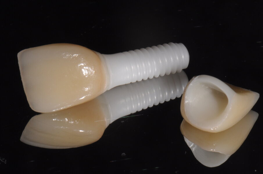 Fig. 13 - Utilizzo di un analogo dell’impianto in zirconia e visione delle due corone finalizzate.