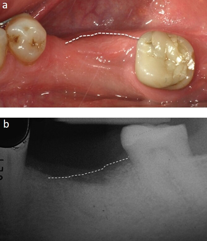 Fig. 4 - a: spessore crestale a 8 mesi dalla chirurgia rigenerativa. b: radiografia endorale a 8 mesi, vi è un buon mantenimento del profilo crestale.