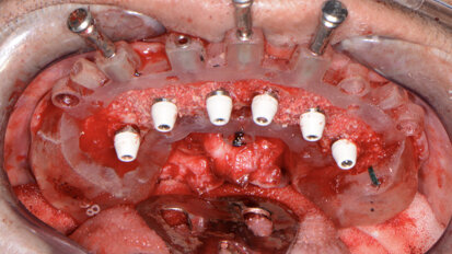 Predictable guided implant placement for full-mouth reconstruction
