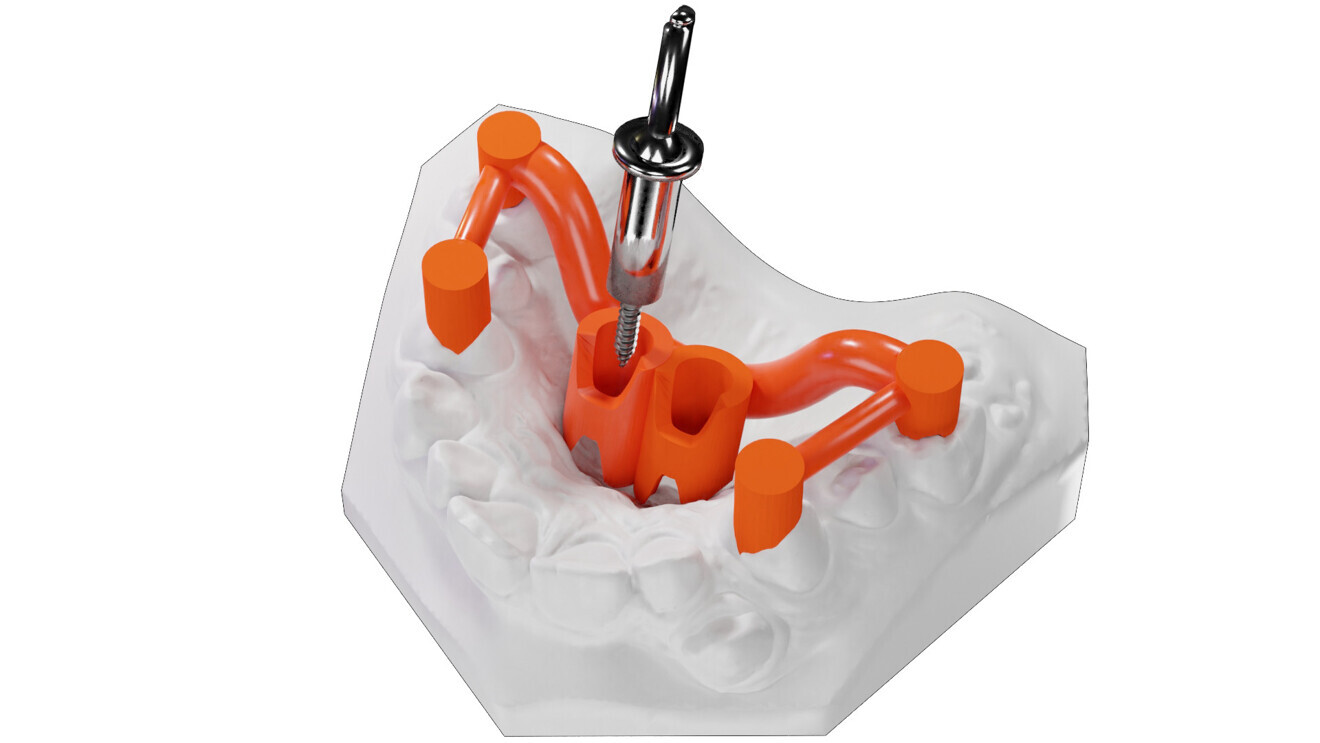 Fig. 2: CAD/CAM insertion guide.
