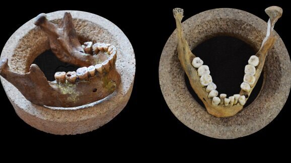 Study finds even earliest farmers had malocclusion