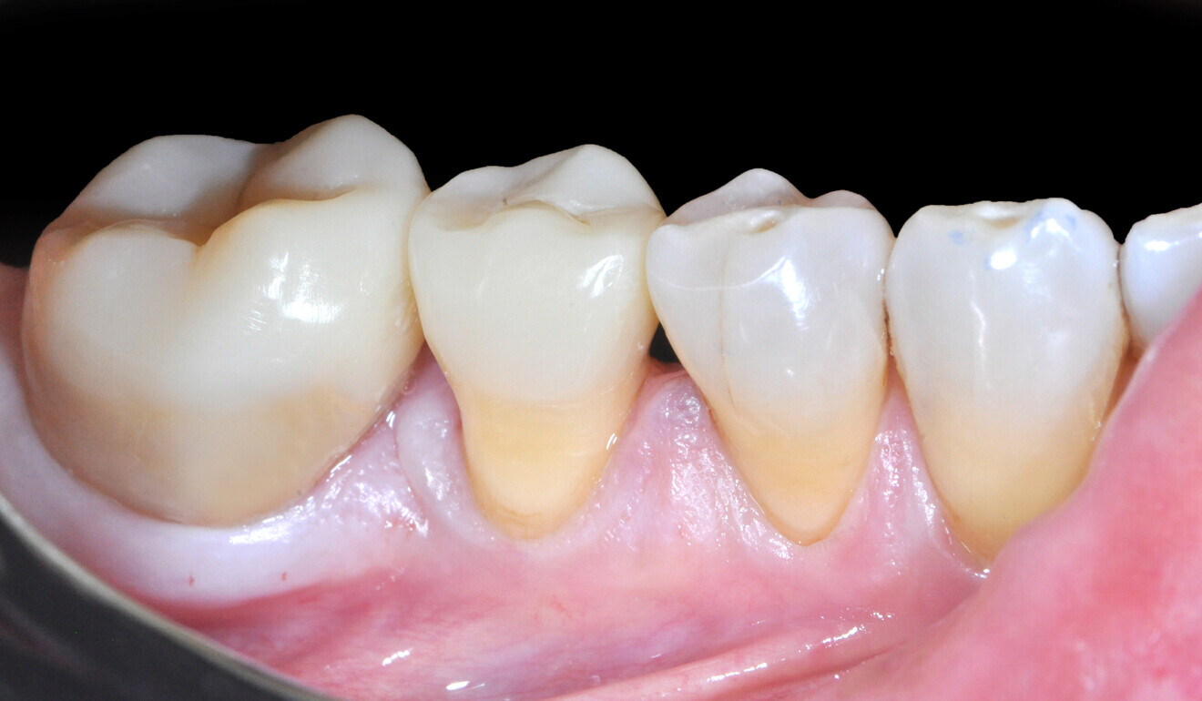 Fig. 28: Treatment outcome, buccal view. 
