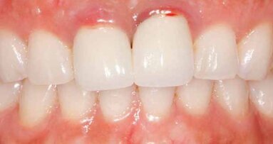 Solid zirconia restoration
